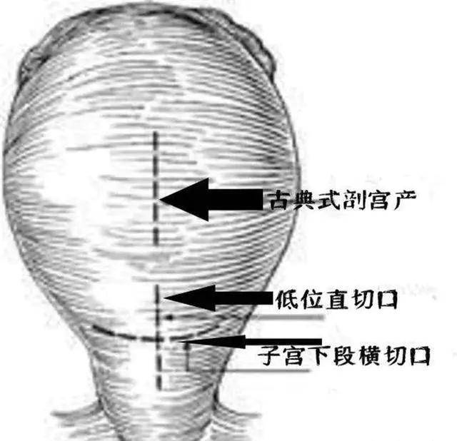 子宫肌瘤刀口位置图片图片