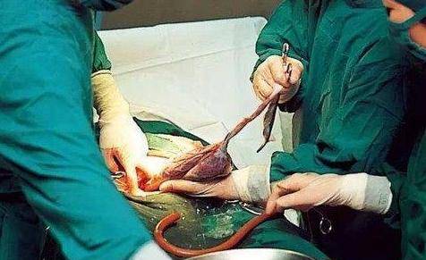 剖宫产手术全程实拍照片图解,生产完的妈妈好多都不清楚