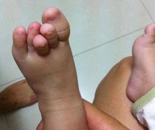 宝妈的小宝也也是脚趾重叠不在一个平面,她的宝宝要比你宝宝大很多!