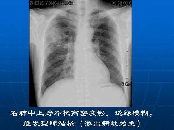 各型肺结核的典型影像表现