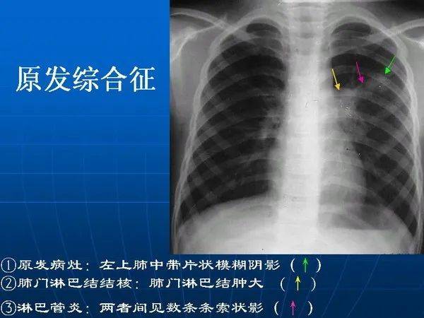 原发性肺结核x线表现图片