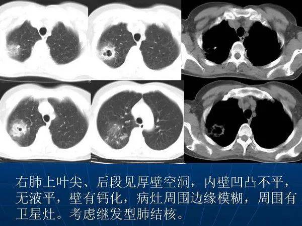 肺结核肺癌ct图片图解图片