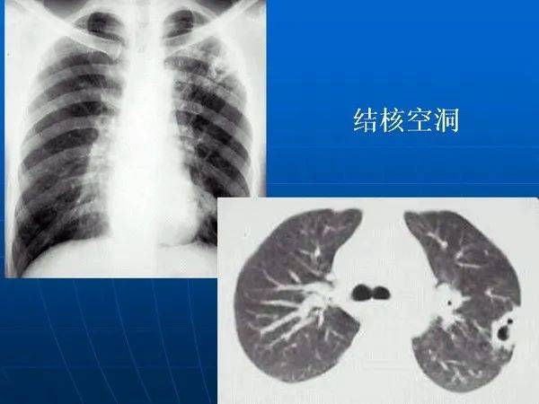 原发性肺结核图片