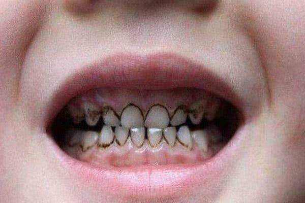 孩子牙齿发黑怎么办?究其原因,逐个击破,做好这三点!