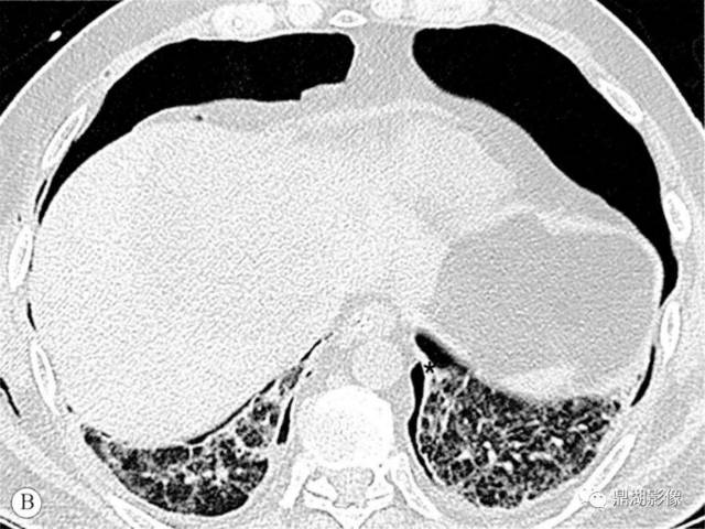 胸部ct天天见,却不认识的结构:肺韧带