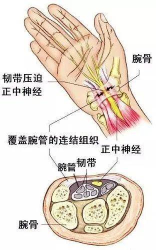 手指僵硬手腕酸痛警惕腕管综合征