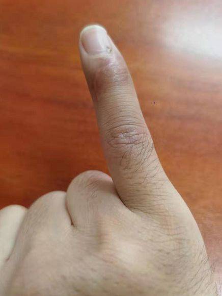 【筋骨堂】戳伤手指,警惕"锤状指"