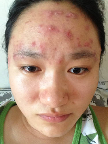 脸上爆痘的人注意了,医生警惕:3个原因别再碰,那是自找麻烦!