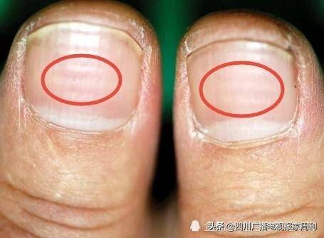 指甲上出现博氏线