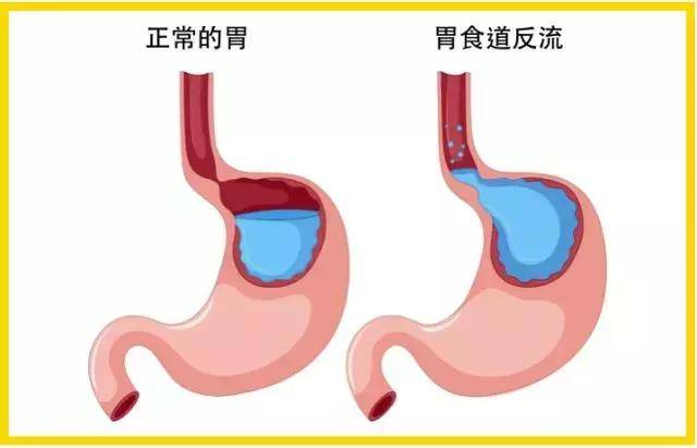 胃食管反流图解图片