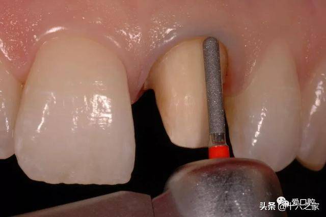 如果肩台制作不到位或不做,修复体与牙齿的接合就会不密贴甚至有缝隙