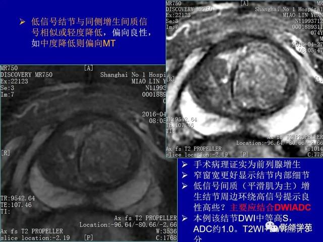 磁共振前列腺图像解析图片