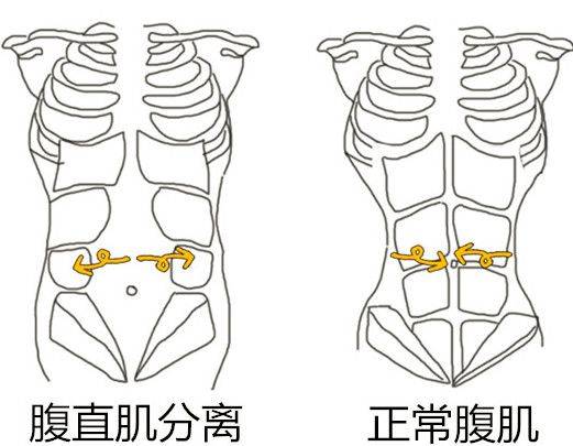 腹直肌分离卡通图片图片