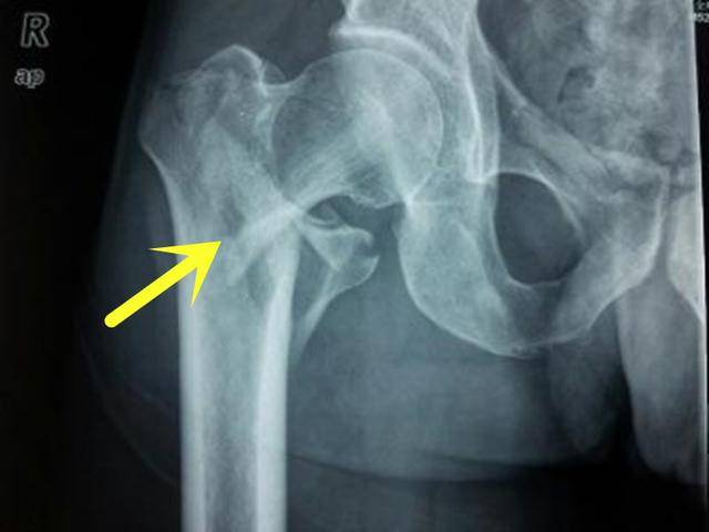 左股骨粗隆间骨折图片