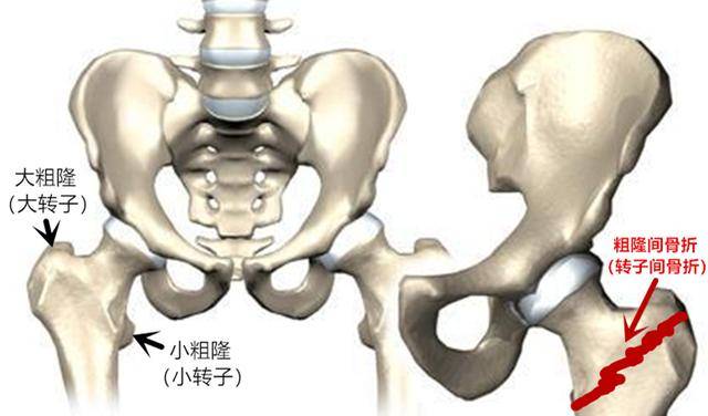 股骨大粗隆位置图图片