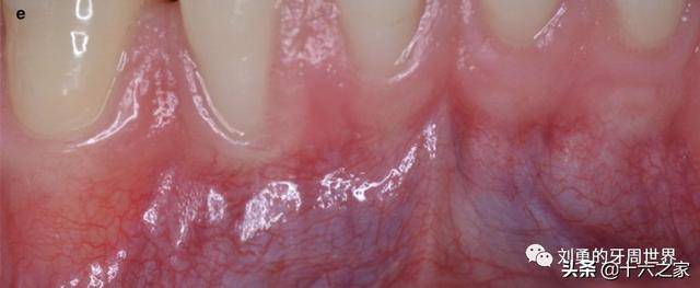牙龈游离龈附着龈图片图片