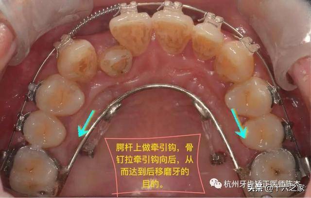 磨牙后推器安装步骤图片