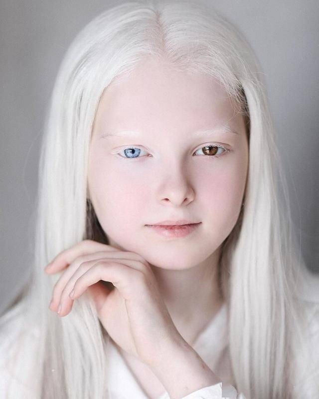 最漂亮的白化病人照片图片