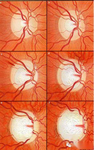 【世界青光眼周】视神经一张照,青光眼早知道
