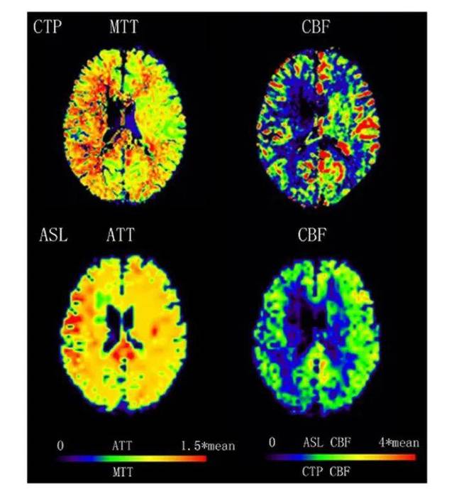 文獻編譯| 煙霧病磁共振asl成像與ct灌注成像的比較- 趙繼宗 王炯炯等