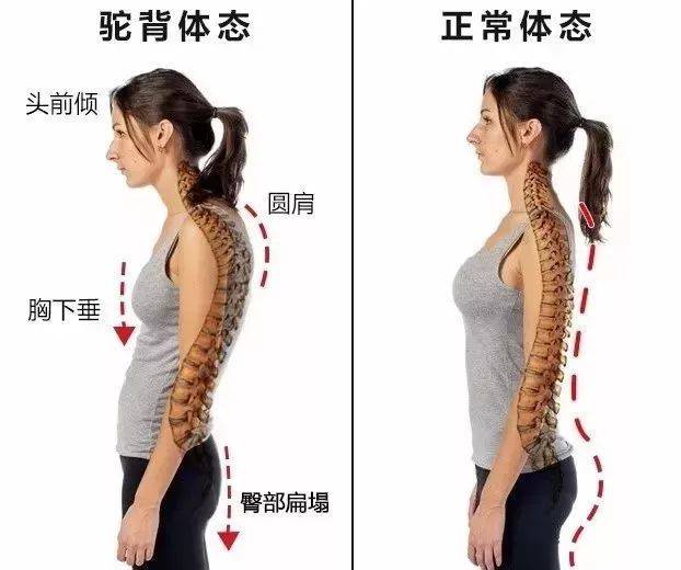 含胸驼背肩内扣?5个动作来改善,让你身姿挺拔,体态年轻