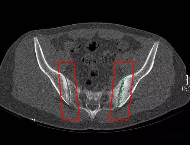 传说中的竹节样改变,一眼识别强直性脊柱炎