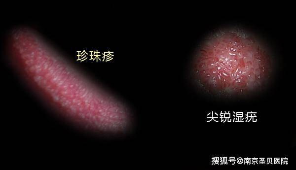 南京圣贝科普分享:珍珠疹和尖锐湿疣图片