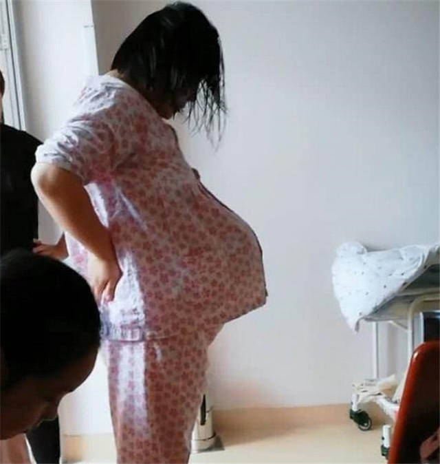 孕妇悬垂腹图片