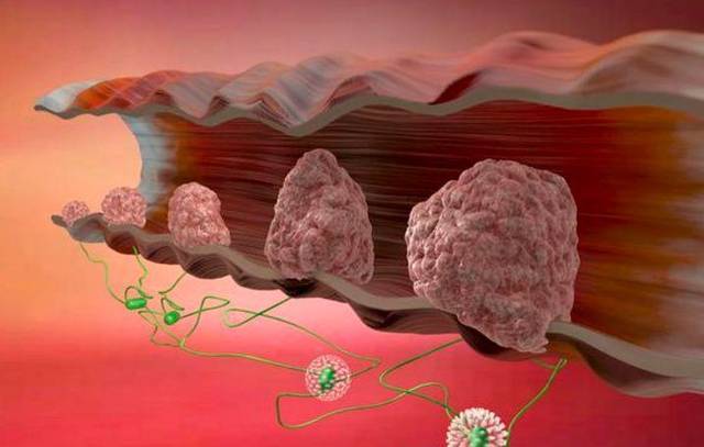 早期腸癌症狀不明顯,排便出現3種信號,及時查腸鏡