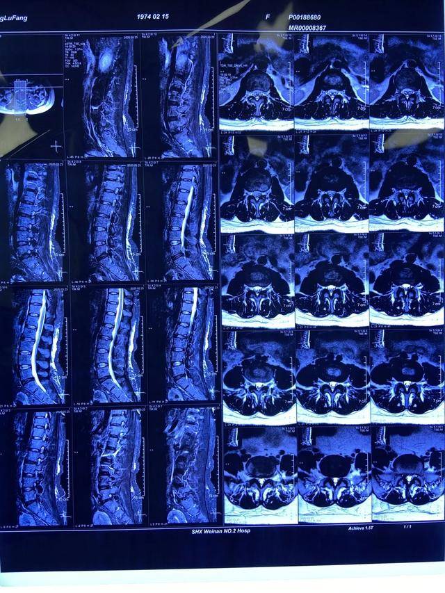 渭南市第二医院神经脊柱外科成功治愈腰5-骶1腰间盘突出症患者