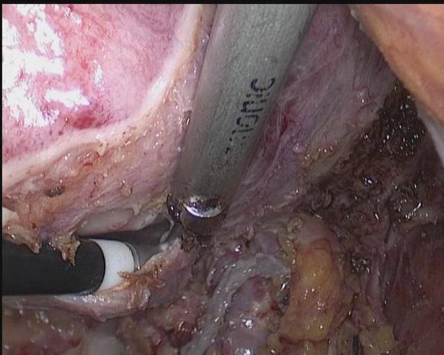 渭南市第二医院肿瘤胸外科完成首例腹部无切口腔镜直肠癌根治术