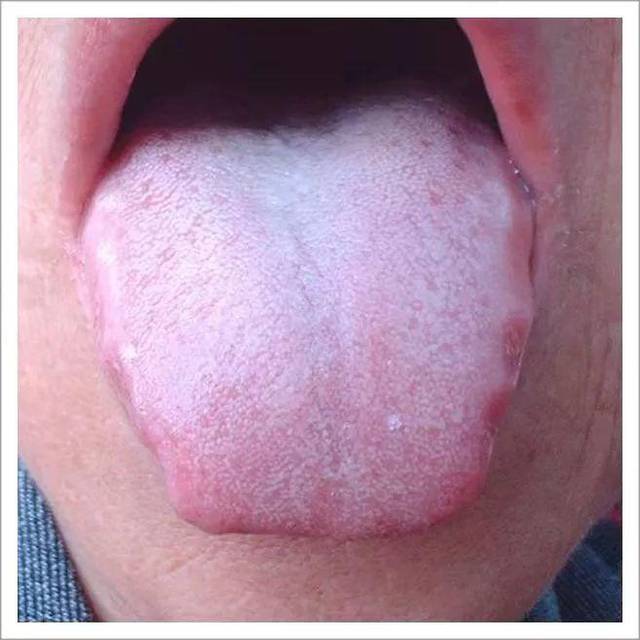 舌头侧面紫色淤点图片