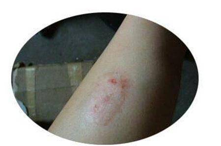 皮肤病:皮癣与牛皮癣到底有什么区别?