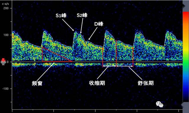 你所不知道的经颅多普勒(4):正常血流频谱和参数