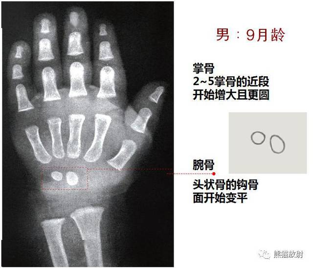 收藏丨骨齡圖譜!(方便隨時對照)_手機搜狐網