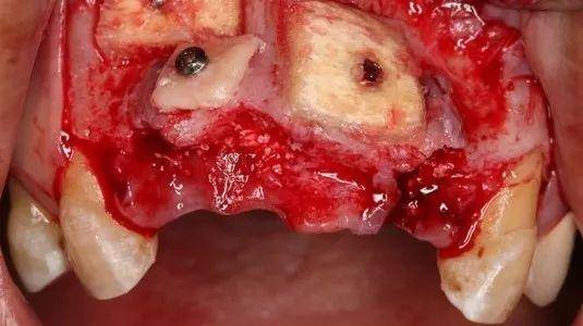 病例| 同种异体骨块在口腔种植中重度骨缺损的应用