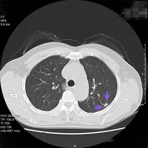 肺部实性结节图片