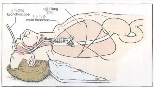 全国肿瘤防治周系列专题——纤维支气管镜技术的应用