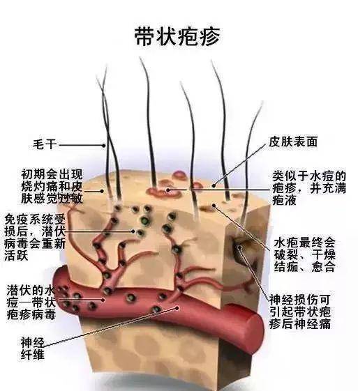 专家带你了解带状疱疹_手机搜狐网