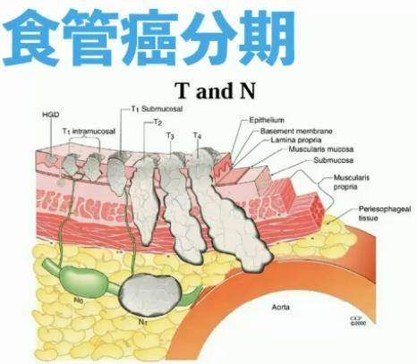 吃不下东西的食管癌