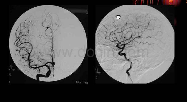 右侧颈内动脉dsa(正常)