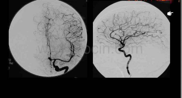 最全的颈部,脑血管图像--教你快速学会看脑血管造影片子