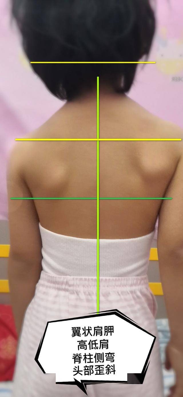 左右胸廓不对称图片图片