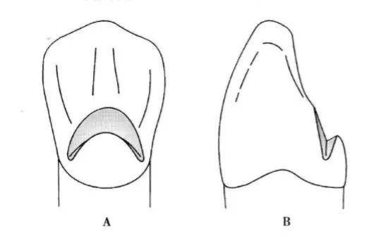 沿牙体长轴放置金刚砂球钻,然后将角度稍稍朝向牙体中心 舌隆突的切