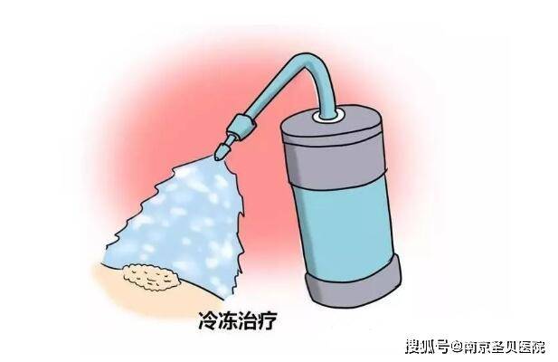 冷凍治療尖銳溼疣效果