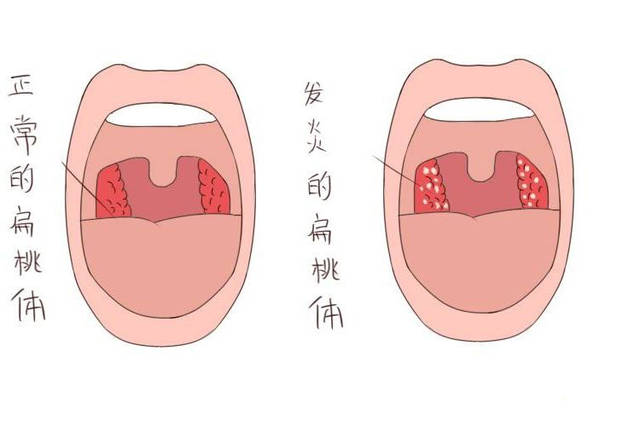 細菌感染扁桃體炎多久才好?_手機搜狐網