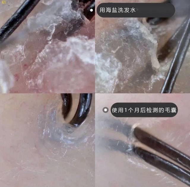 頭蟎造成的溢脂性皮炎不僅讓你瘙癢難忍 讓會損傷頭皮毛囊 讓新的頭髮