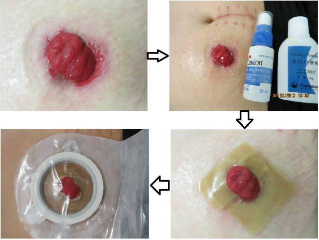 造口周围发生粪水性皮炎,你知道预防和处理吗?