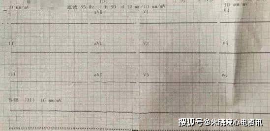 临终三种心电图及结论图片