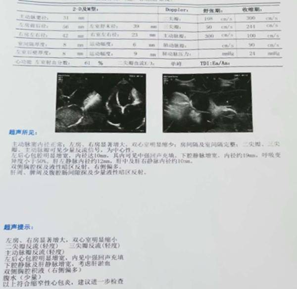 图1 心脏彩超:左房内径(la)56 mm,左室内径(lv)39 mm,右房内径(ra)42